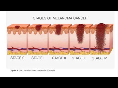 Figure 2. Clark’s melanoma invasion classification