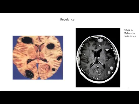 Revelance Figure 3. Melanoma metastases