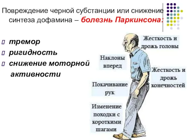 Повреждение черной субстанции или снижение синтеза дофамина – болезнь Паркинсона: тремор ригидность снижение моторной активности