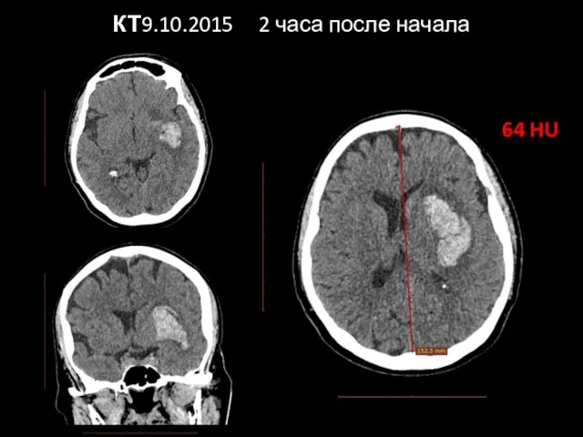 КТ 9.10.2015 2 часа после начала 64 HU