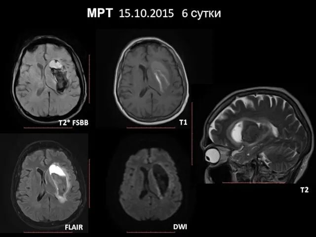 МРТ 15.10.2015 6 сутки T2* FSBB FLAIR T1 DWI T2