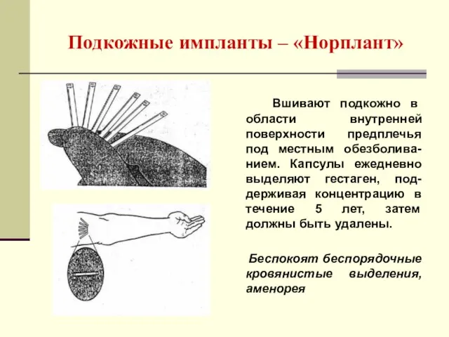 Подкожные импланты – «Норплант» Вшивают подкожно в области внутренней поверхности предплечья под