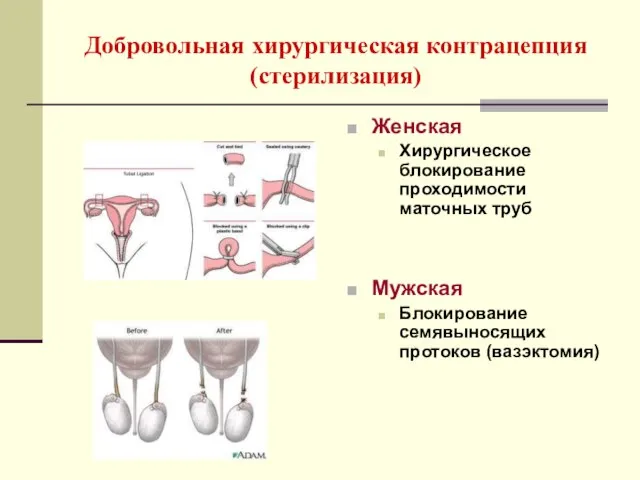 Добровольная хирургическая контрацепция (стерилизация) Женская Хирургическое блокирование проходимости маточных труб Мужская Блокирование семявыносящих протоков (вазэктомия)