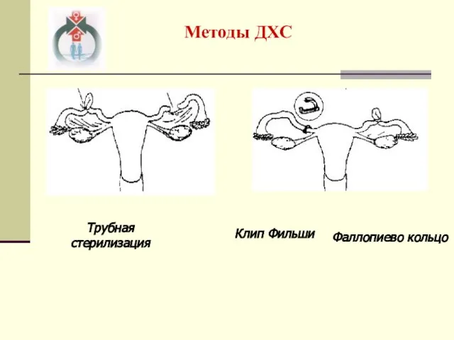 Методы ДХС Клип Фильши Фаллопиево кольцо Трубная стерилизация