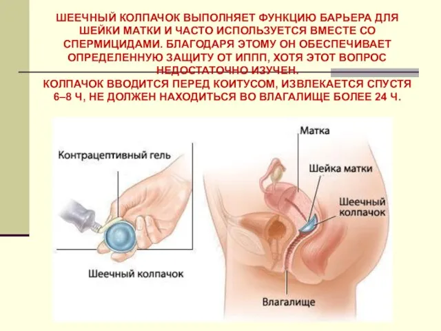 ШЕЕЧНЫЙ КОЛПАЧОК ВЫПОЛНЯЕТ ФУНКЦИЮ БАРЬЕРА ДЛЯ ШЕЙКИ МАТКИ И ЧАСТО ИСПОЛЬЗУЕТСЯ ВМЕСТЕ