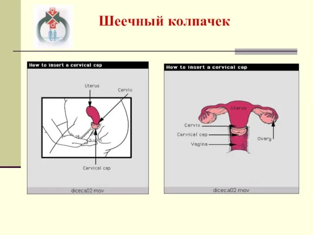 Шеечный колпачек