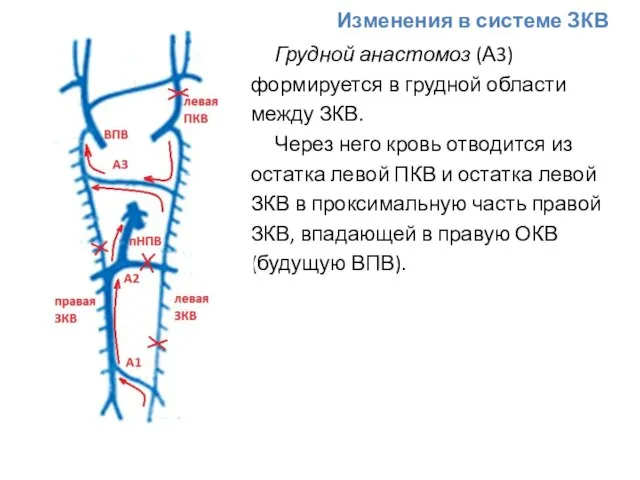 Изменения в системе ЗКВ Грудной анастомоз (А3) формируется в грудной области между