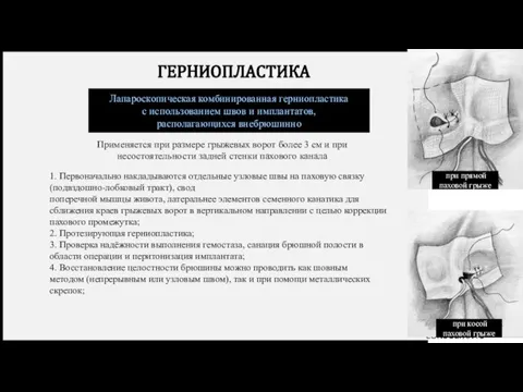 ГЕРНИОПЛАСТИКА Лапароскопическая комбинированная герниопластика с использованием швов и имплантатов, располагающихся внебрюшинно Применяется