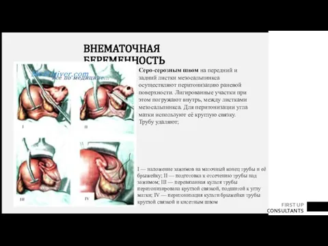 ВНЕМАТОЧНАЯ БЕРЕМЕННОСТЬ I — наложение зажимов на маточный конец трубы и её