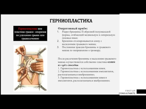 ГЕРНИОПЛАСТИКА Оперативный приём: Разрез брюшины П-образной/полуовальной формы, огибающий медиальную и латеральную паховые