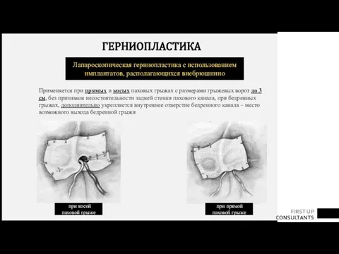 ГЕРНИОПЛАСТИКА Лапароскопическая герниопластика с использованием имплантатов, располагающихся внебрюшинно Применяется при прямых и