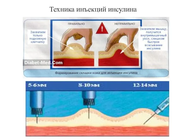 Техника инъекций инсулина