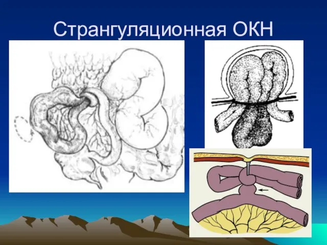 Странгуляционная ОКН