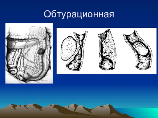 Обтурационная