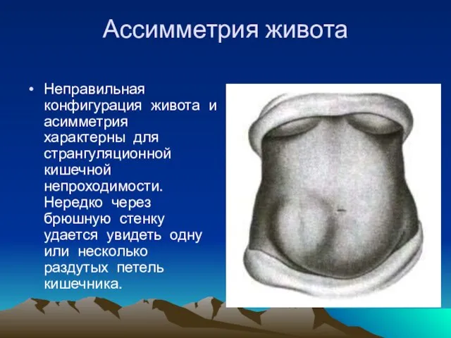 Ассимметрия живота Неправильная конфигурация живота и асимметрия характерны для странгуляционной кишечной непроходимости.