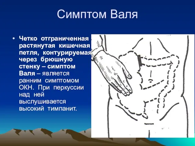 Симптом Валя Четко отграниченная растянутая кишечная петля, контурируемая через брюшную стенку –