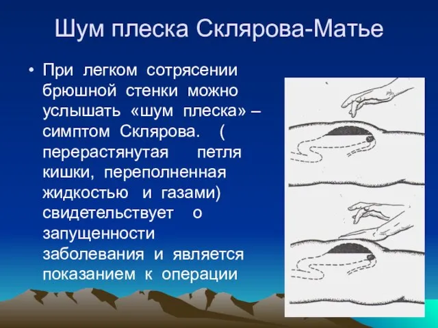 Шум плеска Склярова-Матье При легком сотрясении брюшной стенки можно услышать «шум плеска»