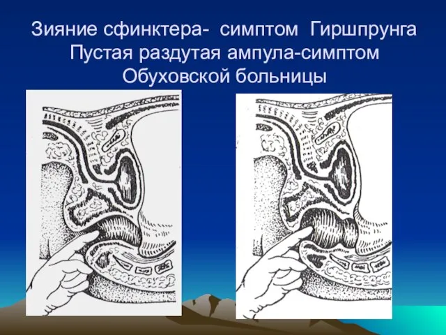 Зияние сфинктера- симптом Гиршпрунга Пустая раздутая ампула-симптом Обуховской больницы