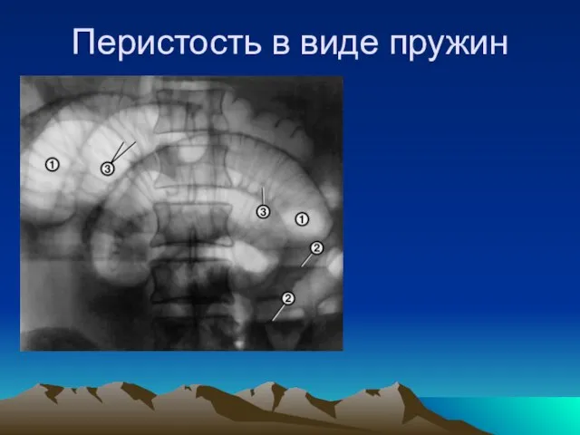 Перистость в виде пружин