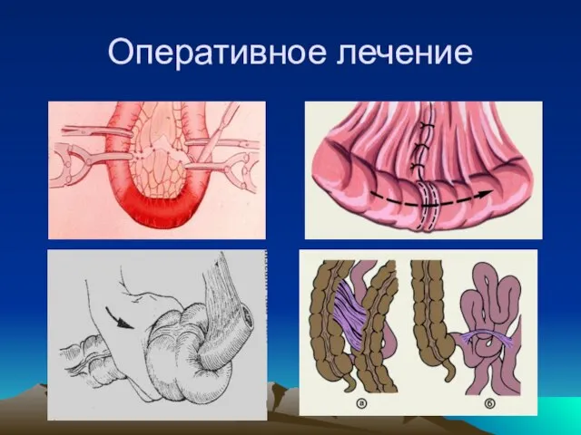 Оперативное лечение