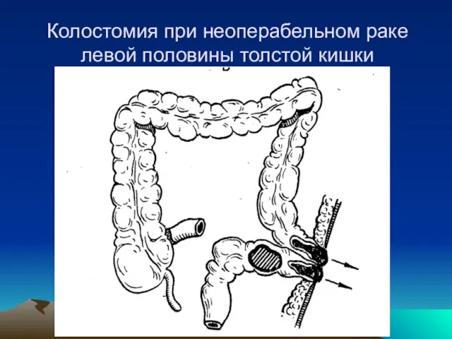 Колостомия при неоперабельном раке левой половины толстой кишки