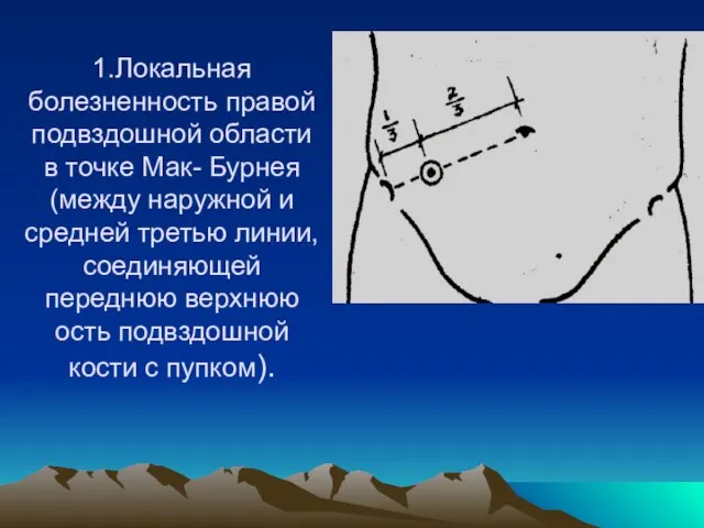 1.Локальная болезненность правой подвздошной области в точке Мак- Бурнея (между наружной и