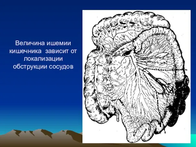 Величина ишемии кишечника зависит от локализации обструкции сосудов