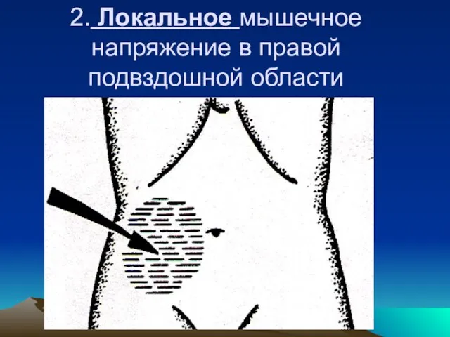 2. Локальное мышечное напряжение в правой подвздошной области