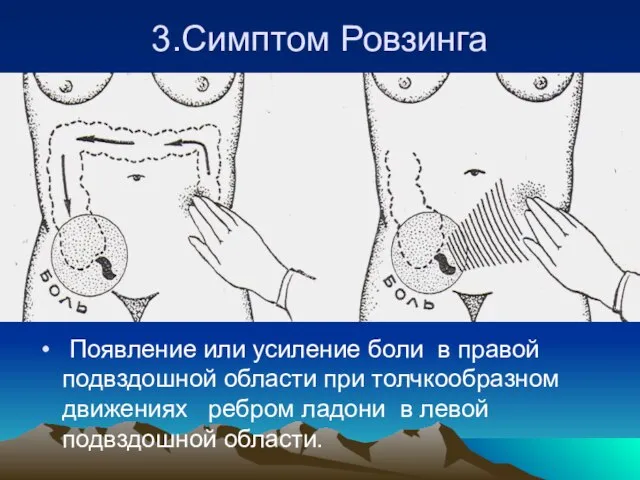 3.Симптом Ровзинга Появление или усиление боли в правой подвздошной области при толчкообразном