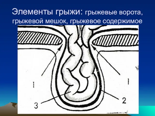 Элементы грыжи: грыжевые ворота, грыжевой мешок, грыжевое содержимое