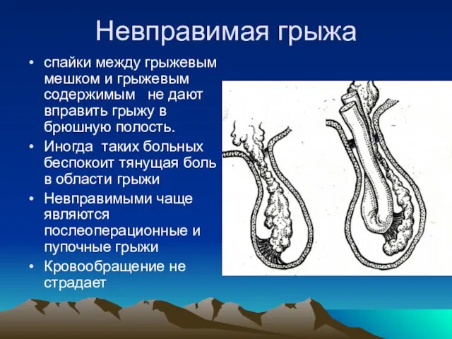 Невправимая грыжа спайки между грыжевым мешком и грыжевым содержимым не дают вправить