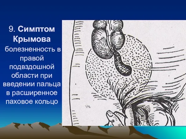 9. Симптом Крымова болезненность в правой подвздошной области при введении пальца в расширенное паховое кольцо
