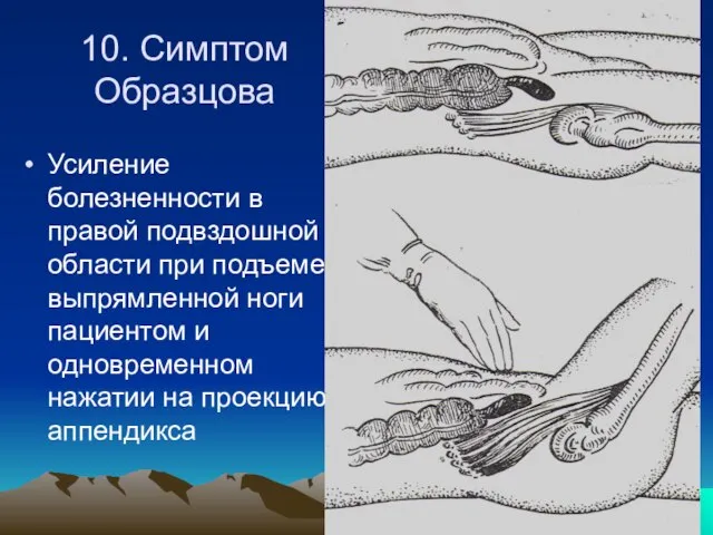 10. Симптом Образцова Усиление болезненности в правой подвздошной области при подъеме выпрямленной