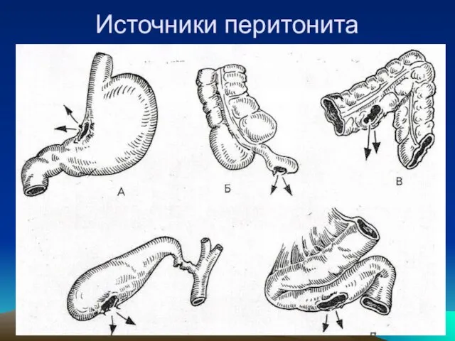 Источники перитонита