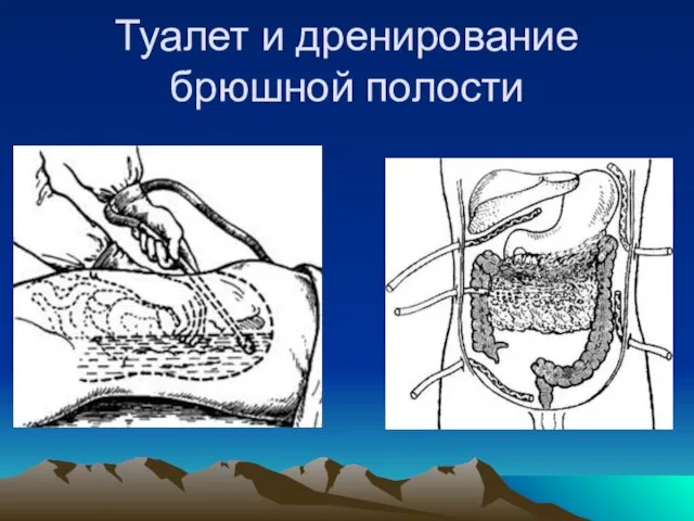 Туалет и дренирование брюшной полости