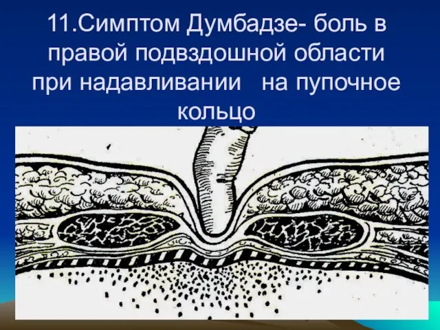 11.Симптом Думбадзе- боль в правой подвздошной области при надавливании на пупочное кольцо