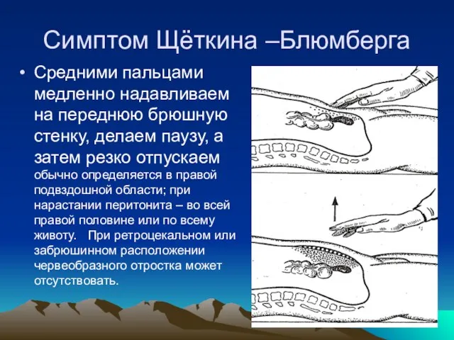 Симптом Щёткина –Блюмберга Средними пальцами медленно надавливаем на переднюю брюшную стенку, делаем