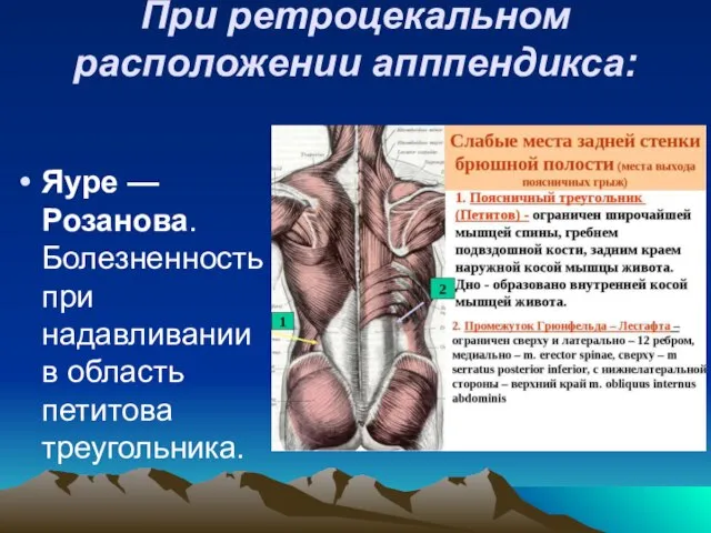 При ретроцекальном расположении апппендикса: Яуре — Розанова. Болезненность при надавливании в область петитова треугольника.