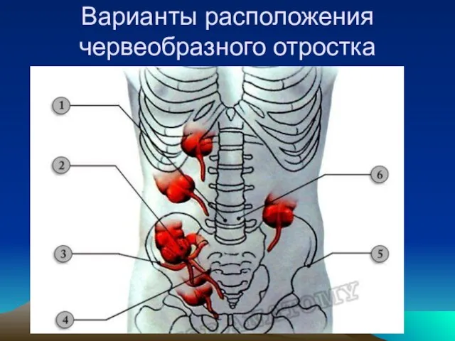 Варианты расположения червеобразного отростка