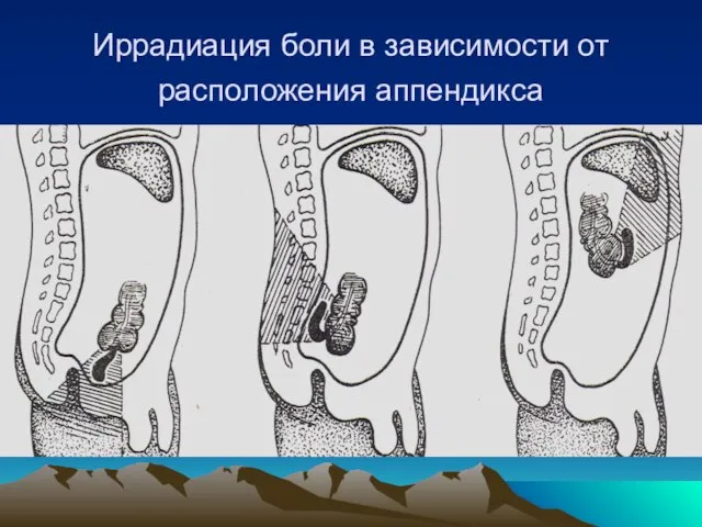 Иррадиация боли в зависимости от расположения аппендикса