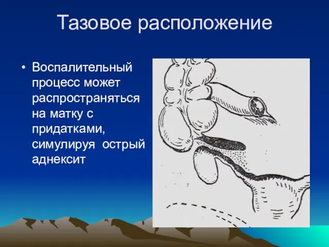 Тазовое расположение Воспалительный процесс может распространяться на матку с придатками, симулируя острый аднексит