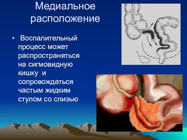 Медиальное расположение Воспалительный процесс может распространяться на сигмовидную кишку и сопровождаться частым жидким стулом со слизью