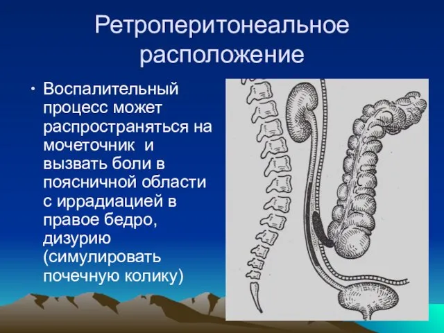 Ретроперитонеальное расположение Воспалительный процесс может распространяться на мочеточник и вызвать боли в