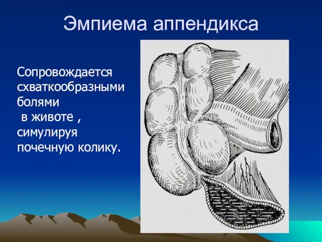 Эмпиема аппендикса Сопровождается схваткообразными болями в животе , симулируя почечную колику.