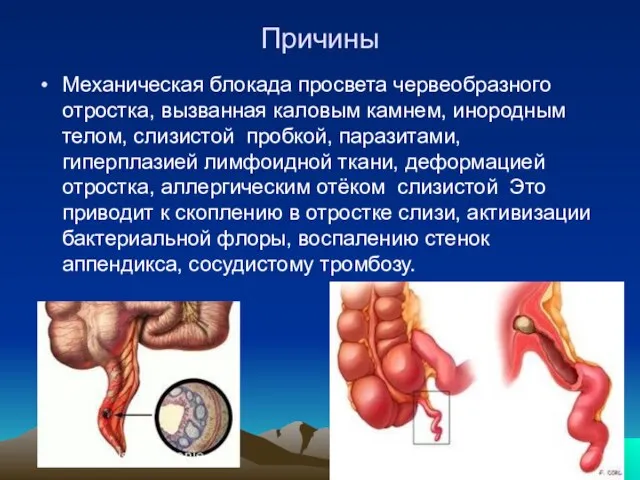 Причины Механическая блокада просвета червеобразного отростка, вызванная каловым камнем, инородным телом, слизистой