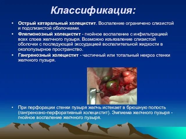 Классификация: Острый катаральный холецистит. Воспаление ограничено слизистой и подслизистой оболочками. Флегмонозный холецистит