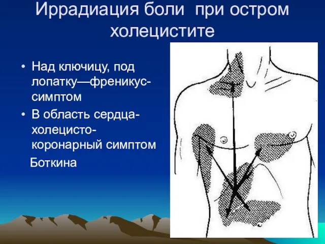 Иррадиация боли при остром холецистите Над ключицу, под лопатку—френикус-симптом В область сердца-холецисто-коронарный симптом Боткина