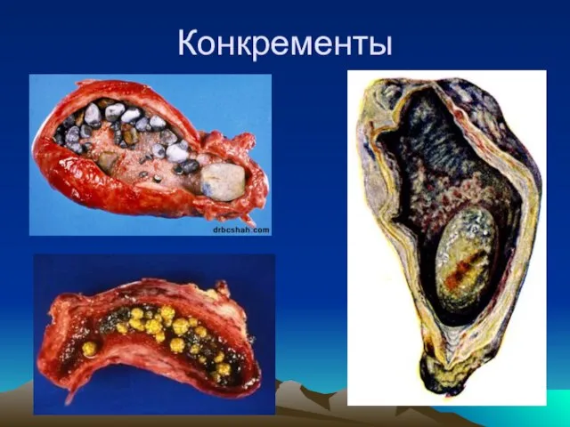 Конкременты