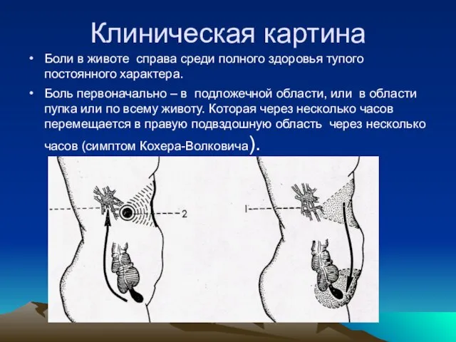 Клиническая картина Боли в животе справа среди полного здоровья тупого постоянного характера.