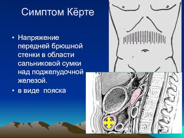 Симптом Кёрте Напряжение передней брюшной стенки в области сальниковой сумки над поджелудочной железой. в виде пояска